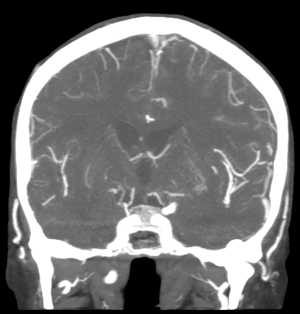 Cerebral arteriovenous malformation with lobar hemorrhage (Radiopaedia 44725-48511 B 28).png
