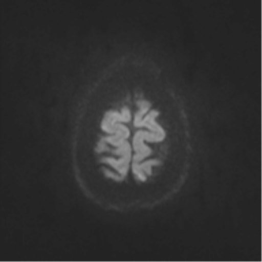 File:Cerebral cavernoma and development venous anomaly (Radiopaedia 37603-39482 Axial DWI 44).png