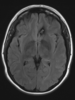 File:Cerebral cavernoma and development venous anomaly (Radiopaedia 37603-39482 Axial FLAIR 11).png