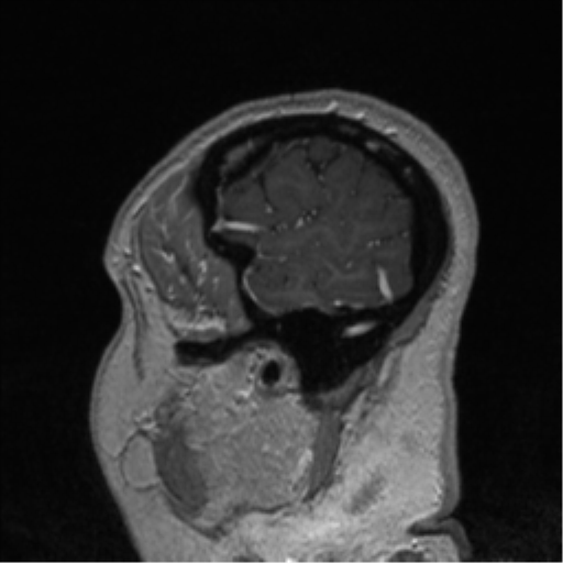 Cerebral cavernoma and development venous anomaly (Radiopaedia 37603-39482 Sagittal T1 C+ 14).png