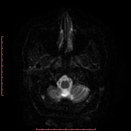 File:Cerebral cavernous malformation (Radiopaedia 26177-26306 Axial DWI 24).jpg