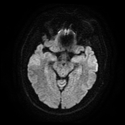 Cerebral cavernous venous malformation (Zabramski type II) (Radiopaedia 85511-101198 Axial DWI 47).jpg