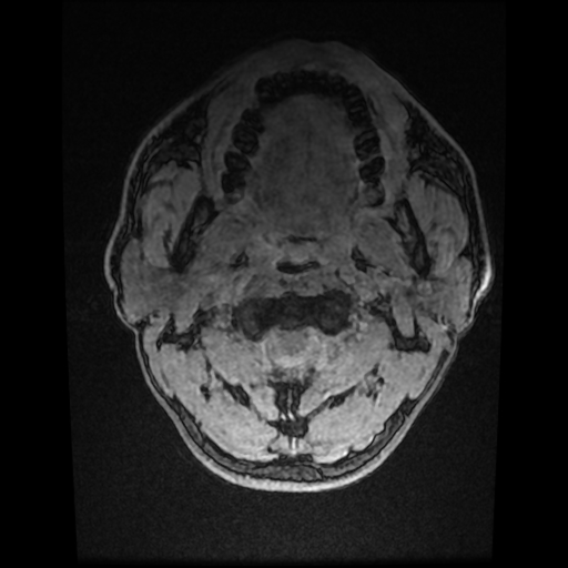 Cerebral cavernous venous malformation (Zabramski type II) (Radiopaedia 85511-101198 Axial T1 C+ fat sat 1).jpg