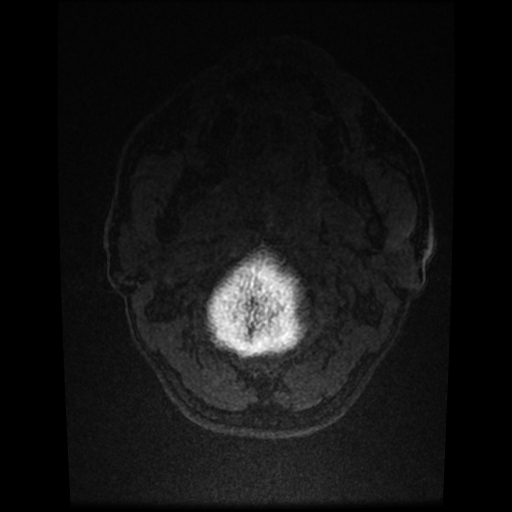 Cerebral cavernous venous malformation (Zabramski type II) (Radiopaedia 85511-101198 Axial T1 C+ fat sat 4).jpg