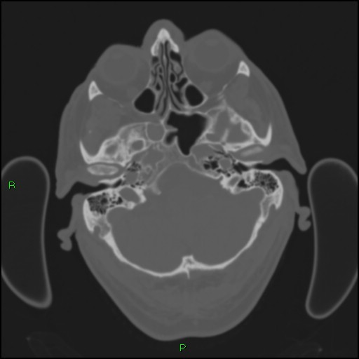 Cerebral contusions (Radiopaedia 33868-35039 Axial bone window 33).jpg