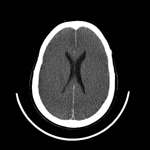 File:Cerebral edema (evolution in time) (Radiopaedia 19418-19439 non-contrast 61).jpg