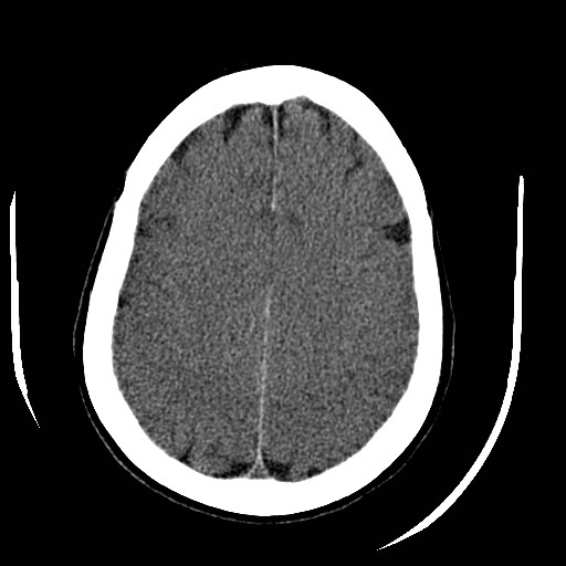 File:Cerebral edema (evolution in time) (Radiopaedia 19418-19440 non-contrast 69).jpg