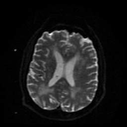 Cerebral embolic infarcts (embolic shower) (Radiopaedia 49837-55108 Axial DWI 18).jpg