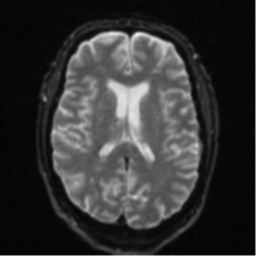 Cerebral embolic infarcts (embolic shower) (Radiopaedia 57395-64342 Axial DWI 21).png