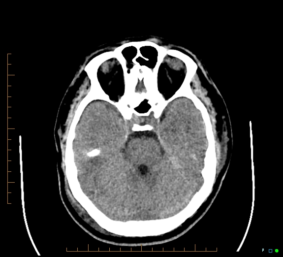 Cerebral fat embolism (Radiopaedia 85521-101220 Axial non-contrast 24).jpg