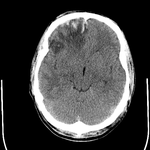 File:Cerebral hemorrhagic contusions- temporal evolution (Radiopaedia 40224-42754 Axial non-contrast 11).png