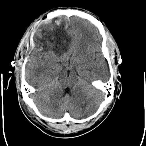 File:Cerebral hemorrhagic contusions- temporal evolution (Radiopaedia 40224-42755 AXIAL THICK 10).png