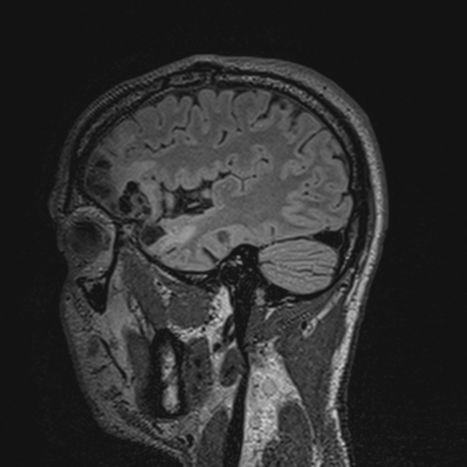 File:Cerebral hemorrhagic contusions- temporal evolution (Radiopaedia 40224-42757 Sagittal T1 62).png