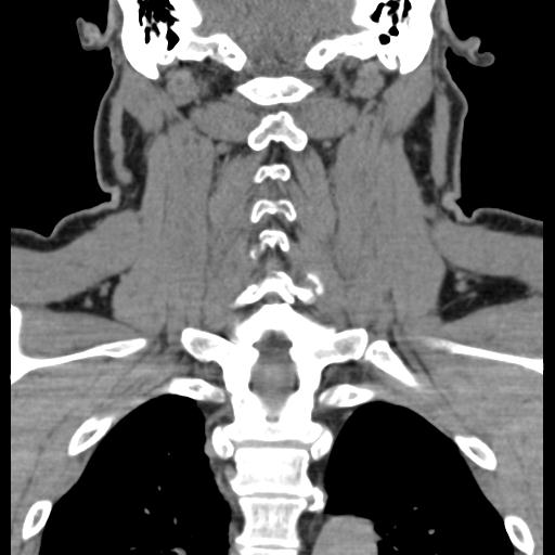 Cerebral hemorrhagic contusions and cervical spine fractures (Radiopaedia 32865-33841 F 1).jpg