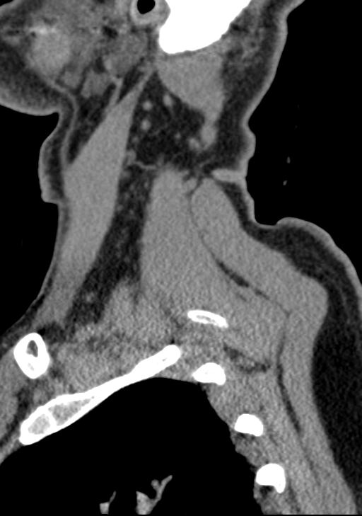 Cerebral hemorrhagic contusions and cervical spine fractures (Radiopaedia 32865-33841 G 17).jpg