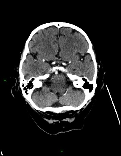 Cerebral metastases - ependymal and parenchymal (Radiopaedia 79877-93131 Axial C+ delayed 20).jpg