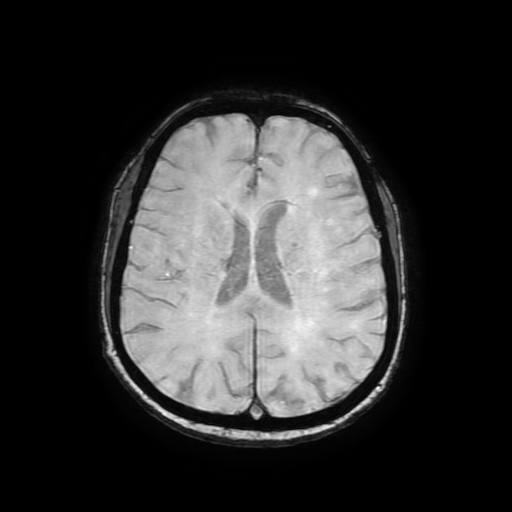 Cerebral metastases - melanoma (Radiopaedia 80972-94522 Axial SWI 62).jpg