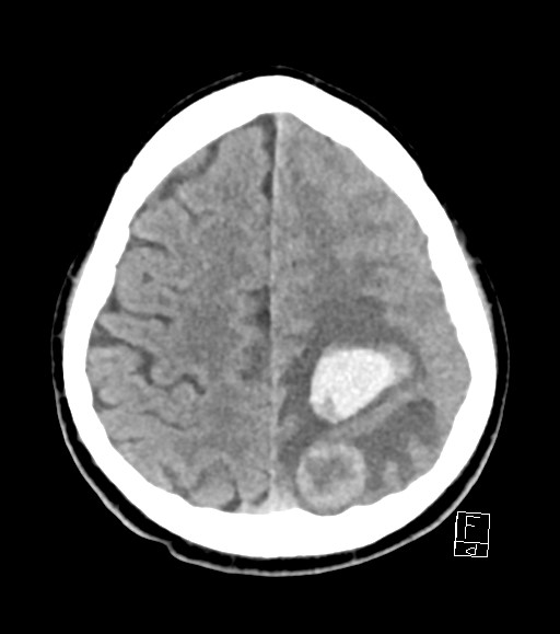 Cerebral metastases - testicular choriocarcinoma (Radiopaedia 84486-99855 Axial non-contrast 16).jpg