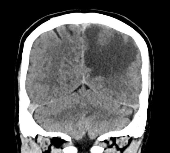Cerebral metastases - testicular choriocarcinoma (Radiopaedia 84486-99855 Coronal C+ delayed 47).jpg