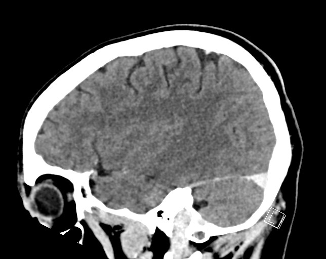 Cerebral metastases - testicular choriocarcinoma (Radiopaedia 84486-99855 F 42).jpg