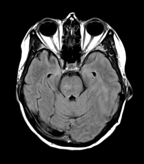 File:Cerebral metastasis (Radiopaedia 46744-51248 Axial FLAIR 9).png