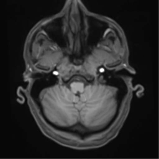 File:Cerebral metastasis - melanoma (Radiopaedia 54718-60954 Axial T1 11).png