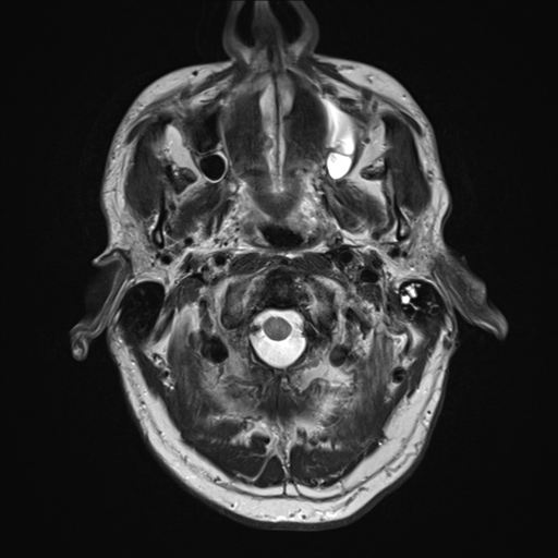 File:Cerebral metastasis - melanoma (Radiopaedia 54718-60954 Axial T2 2).png