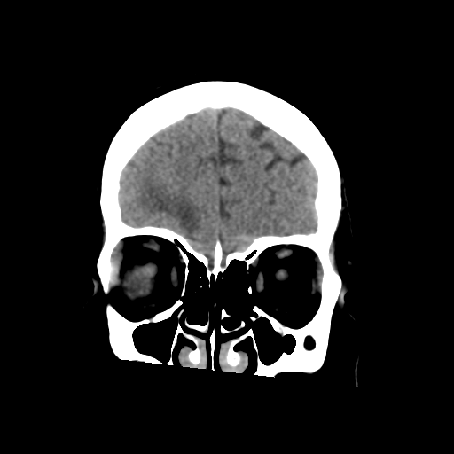 Cerebral metastasis to basal ganglia (Radiopaedia 81568-95412 Coronal non-contrast 17).png