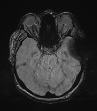Cerebral metastasis to basal ganglia (Radiopaedia 81568-95413 Axial SWI magnitude 26).png