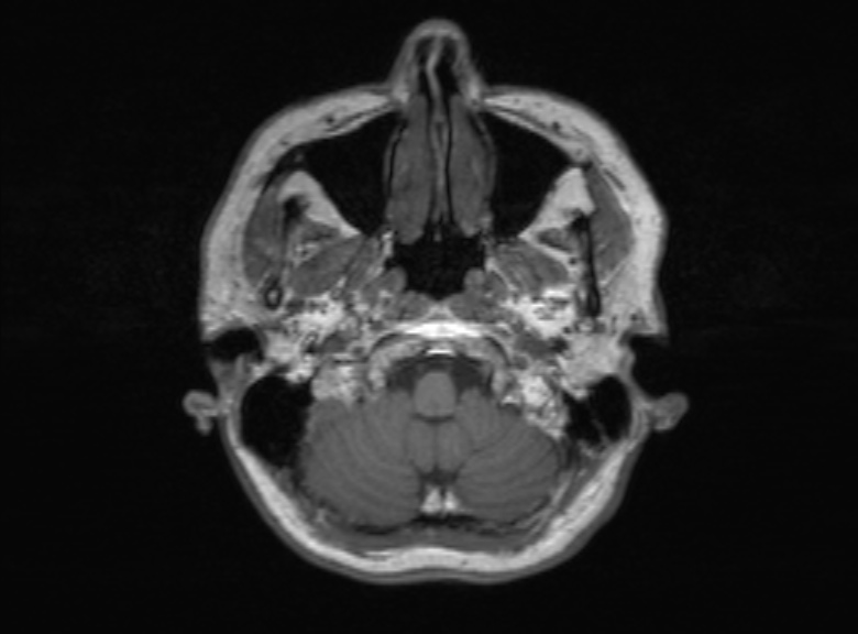 Cerebral ring enhancing lesions - cerebral metastases (Radiopaedia 44922-48817 Axial T1 340).jpg