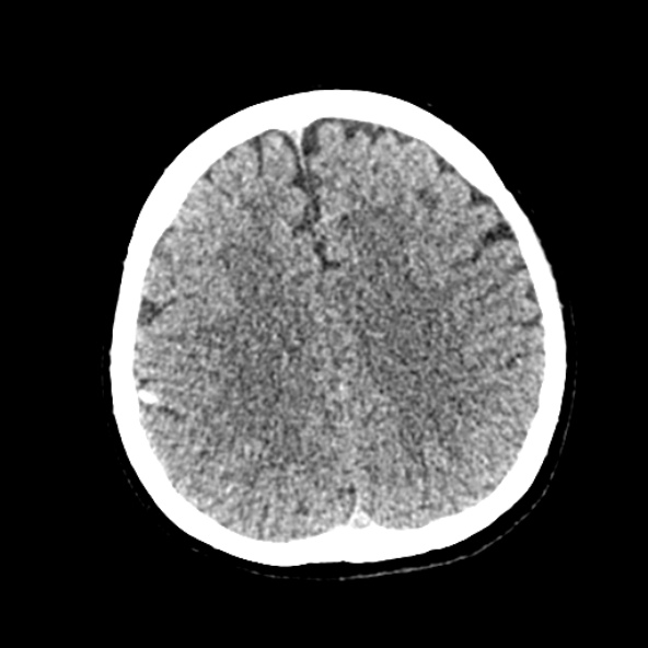 Cerebral ring enhancing lesions - cerebral metastases (Radiopaedia 44922-48818 Axial non-contrast 62).jpg