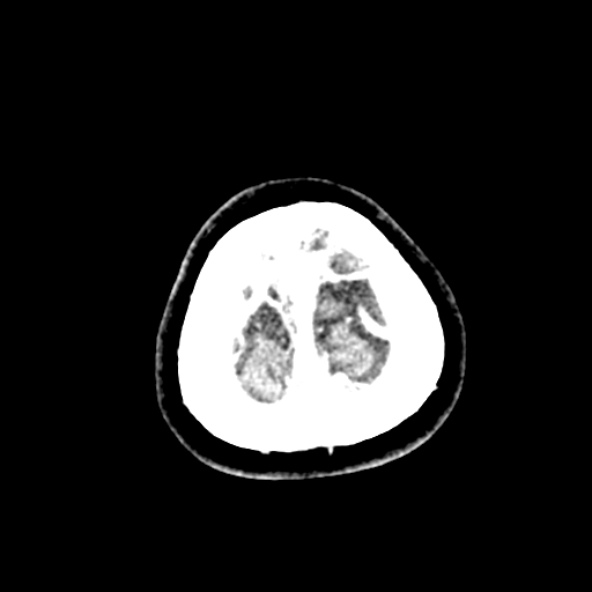 Cerebral ring enhancing lesions - cerebral metastases (Radiopaedia 44922-48818 B 273).jpg