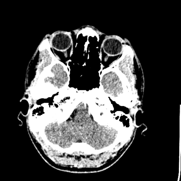 Cerebral toxoplasmosis (Radiopaedia 53993-60131 Axial C+ delayed 14).jpg
