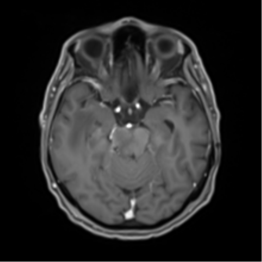 Cerebral toxoplasmosis (Radiopaedia 54575-60804 Axial T1 C+ 22).png