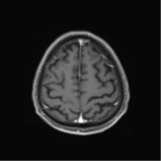 Cerebral toxoplasmosis (Radiopaedia 54575-60804 Axial T1 C+ 45).png