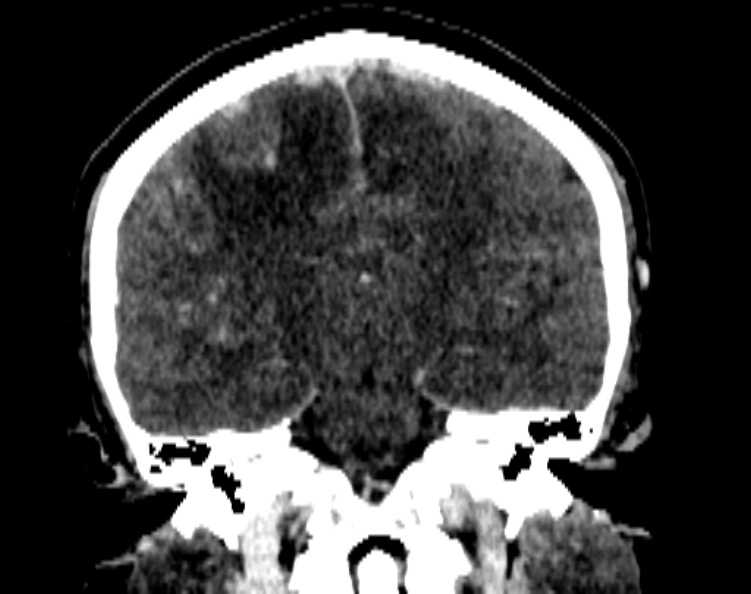 File:Cerebral venous hemorrhagic infarct from venous sinus thrombosis (Radiopaedia 55433-61883 Coronal C+ delayed 36).jpg