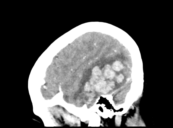 Cerebral venous hemorrhagic infarction (Radiopaedia 57576-64538 Sagittal C+ 11).png