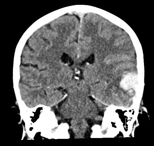 Cerebral venous infarction with hemorrhage (Radiopaedia 65343-74381 Coronal non-contrast 32).jpg