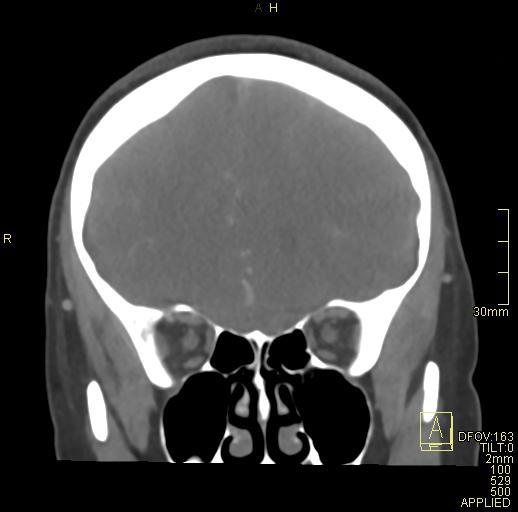 Cerebral venous sinus thrombosis (Radiopaedia 91329-108965 Coronal venogram 26).jpg