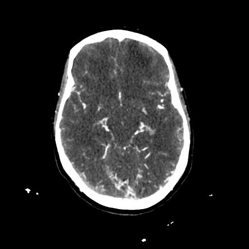 File:Cerebral venous throbmosis - hemorrhagic venous infarction (Radiopaedia 87318-103613 Axial CT venogram 12).jpg