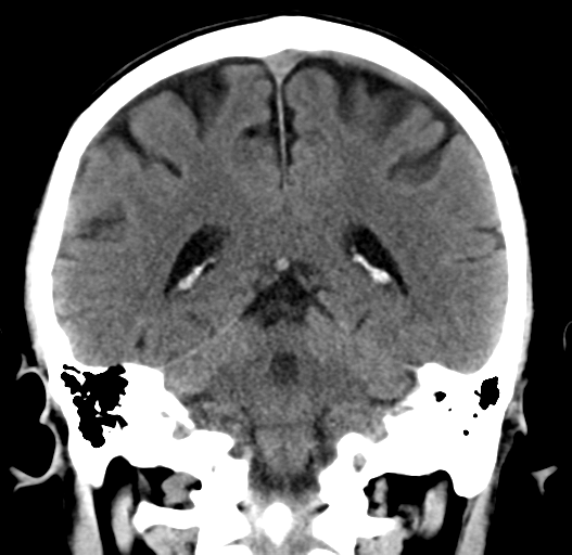 File:Cerebral venous thrombosis (Radiopaedia 38392-40467 Coronal non-contrast 25).png