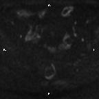 Cervical adenocarcinoma (Radiopaedia 65011-73985 Axial DWI 60).jpg