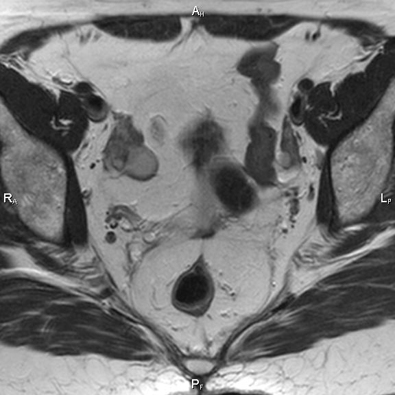 File:Cervical adenocarcinoma (Radiopaedia 65011-73985 Axial T2 23).jpg