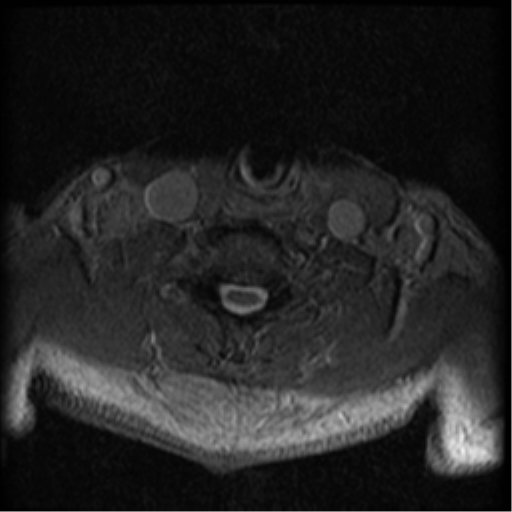Cervical canal stenosis with cord compression (Radiopaedia 34114-35374 Axial Gradient Echo 27).png
