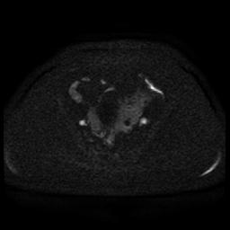 Cervical carcinoma (Radiopaedia 85405-101028 Axial DWI 74).jpg
