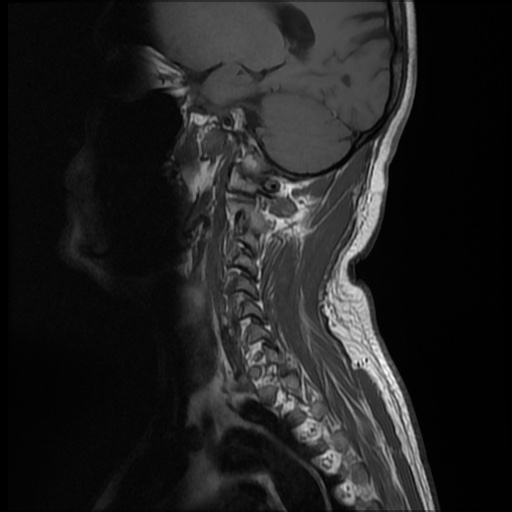 File:Cervical disc extrusion (Radiopaedia 59074-66364 Sagittal T1 10).jpg