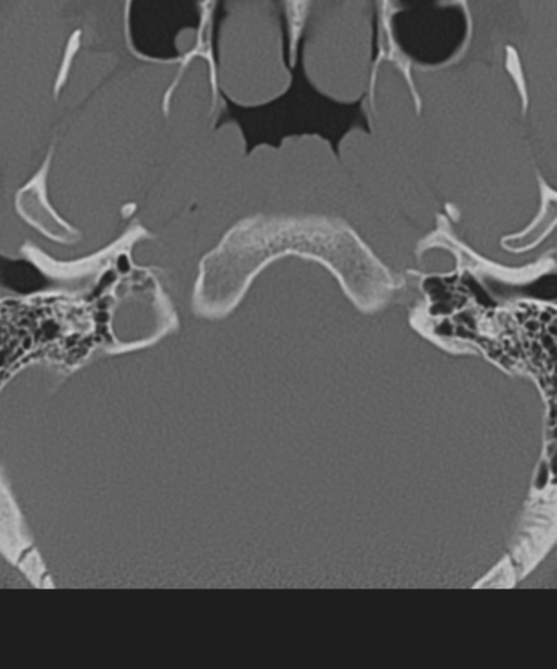 Cervical intercalary bone (Radiopaedia 35211-36748 Axial bone window 4).png