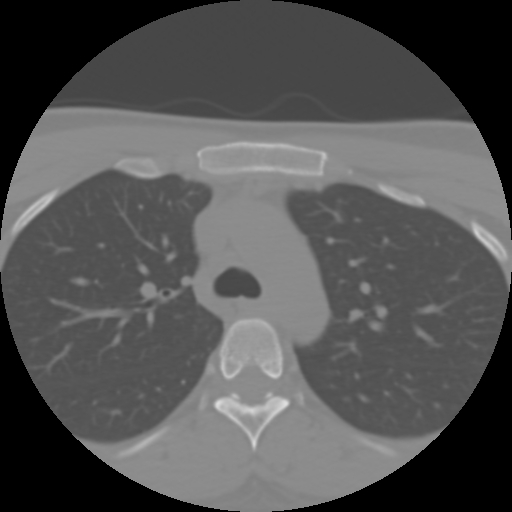 Cervical rib (Radiopaedia 71110-81363 Axial non-contrast 66).jpg