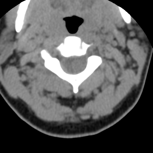 Cervical schwannoma (Radiopaedia 57979-64974 Axial non-contrast 22).png