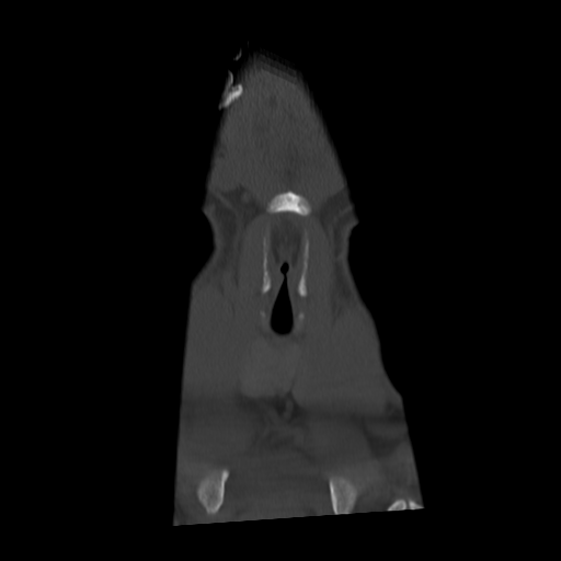Cervical schwannoma (Radiopaedia 57979-64974 Coronal bone window 5).png